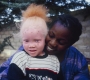 L’ONU contre toute forme de discrimination à l’endroit des albinos